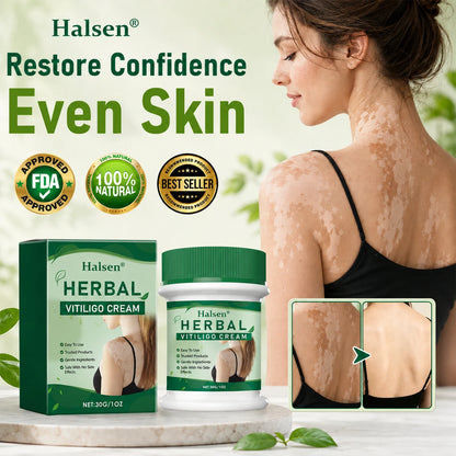 Halsen® Herbal Vitiligo Cream🔥