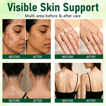 Halsen® Herbal Vitiligo Cream🔥